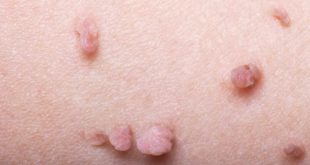 Anal Skin Tags