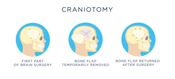 Craniotomy