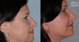 Facelift Surgery